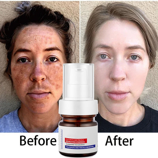 ⚡5-second brightening rescue: Dark spots disappear, blemishes fade, and skin becomes radiant! Vitamin C Whitening Freckles - Lefreniy