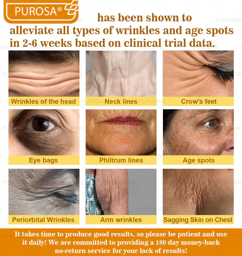 🐝PUROSA® Bee Venom Skin Treatment Cream, Anti-aging, Hydrating, Skin Repair, Even Tone, Acne and Dark Spot Treatment, Wart and Mole Removal, Psoriasis Relief