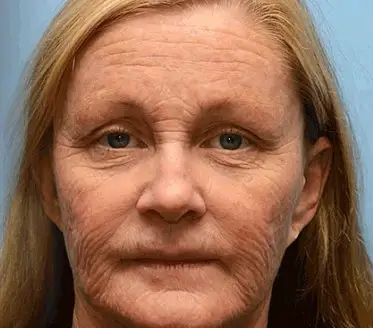 🐝PUROSA® Bee Venom Skin Treatment Cream, Anti-aging, Hydrating, Skin Repair, Even Tone, Acne and Dark Spot Treatment, Wart and Mole Removal, Psoriasis Relief