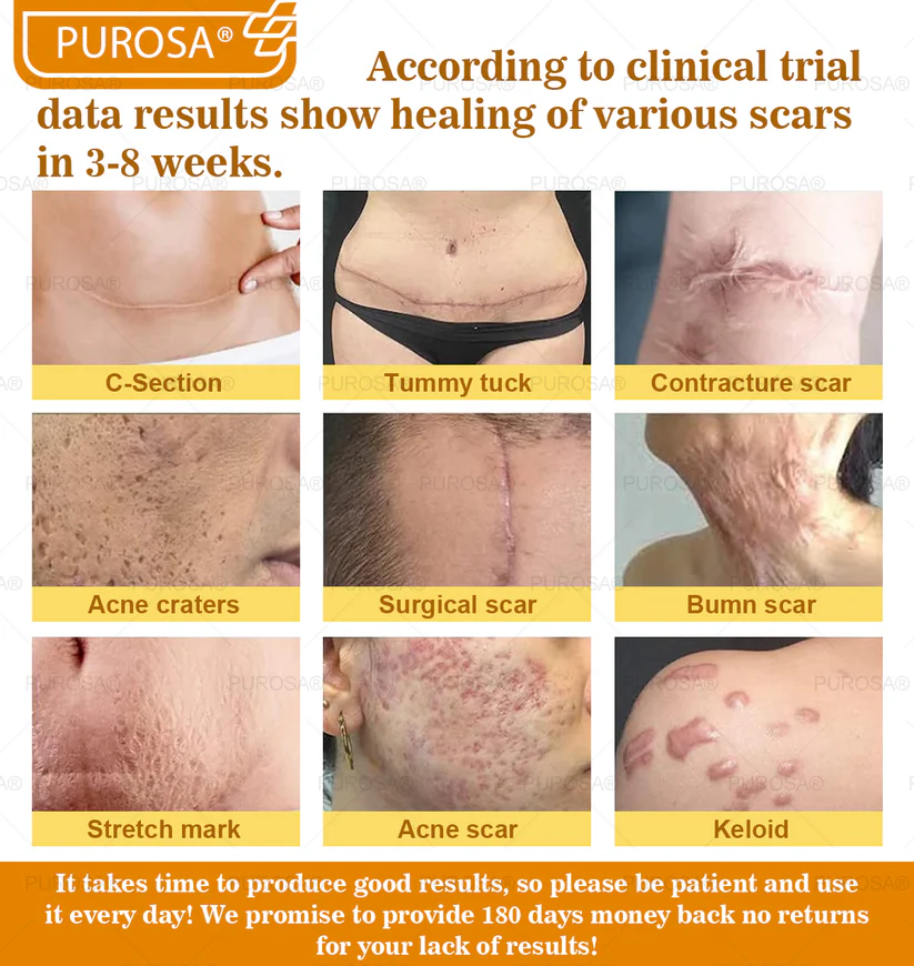 🐝PUROSA® Bee Venom Skin Treatment Cream, Anti-aging, Hydrating, Skin Repair, Even Tone, Acne and Dark Spot Treatment, Wart and Mole Removal, Psoriasis Relief