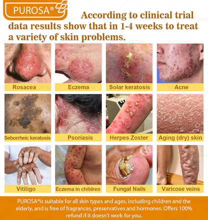 🐝PUROSA® Bee Venom Skin Treatment Cream, Anti-aging, Hydrating, Skin Repair, Even Tone, Acne and Dark Spot Treatment, Wart and Mole Removal, Psoriasis Relief